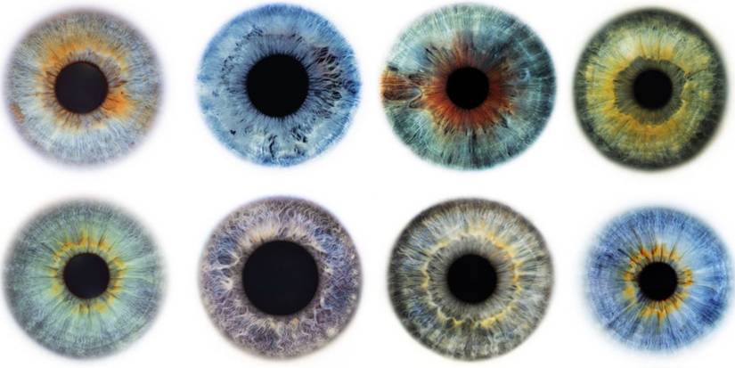 Central Heterochromia